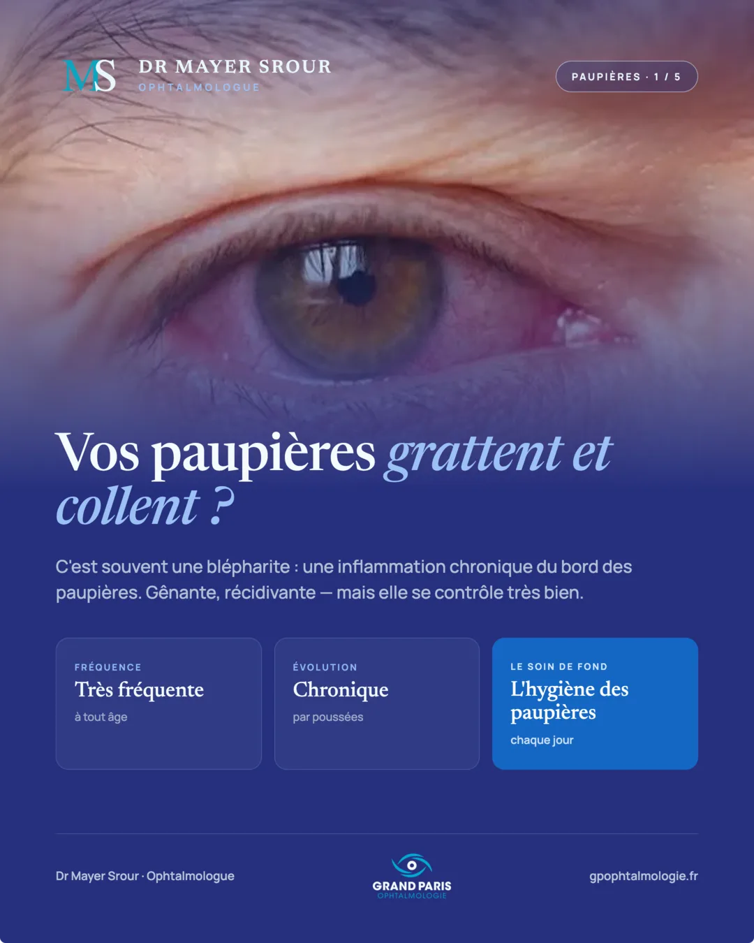 Visuel 1 sur 5 — Vos paupières grattent et collent ?