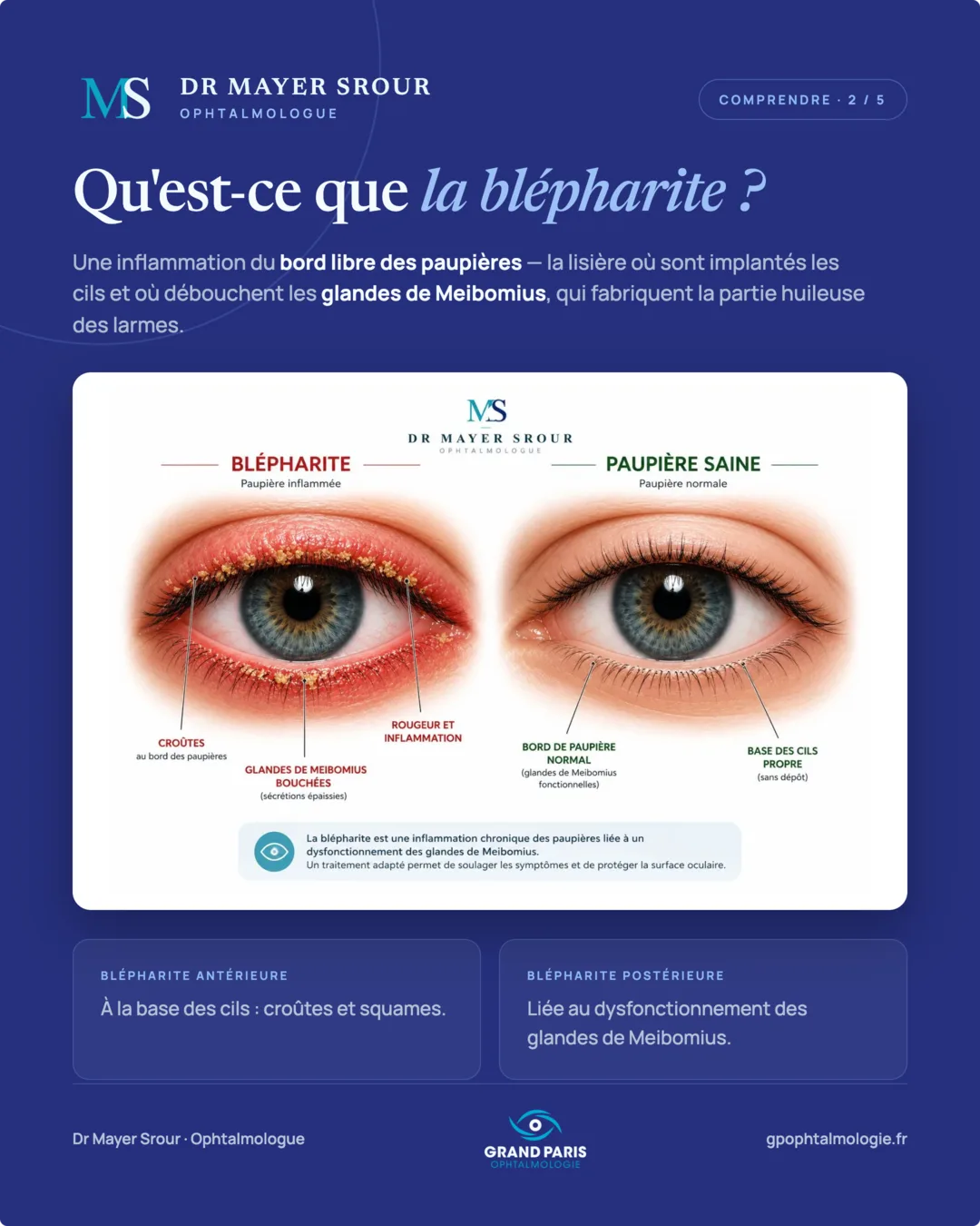 Visuel 2 sur 5 — Qu'est-ce que la blépharite ?