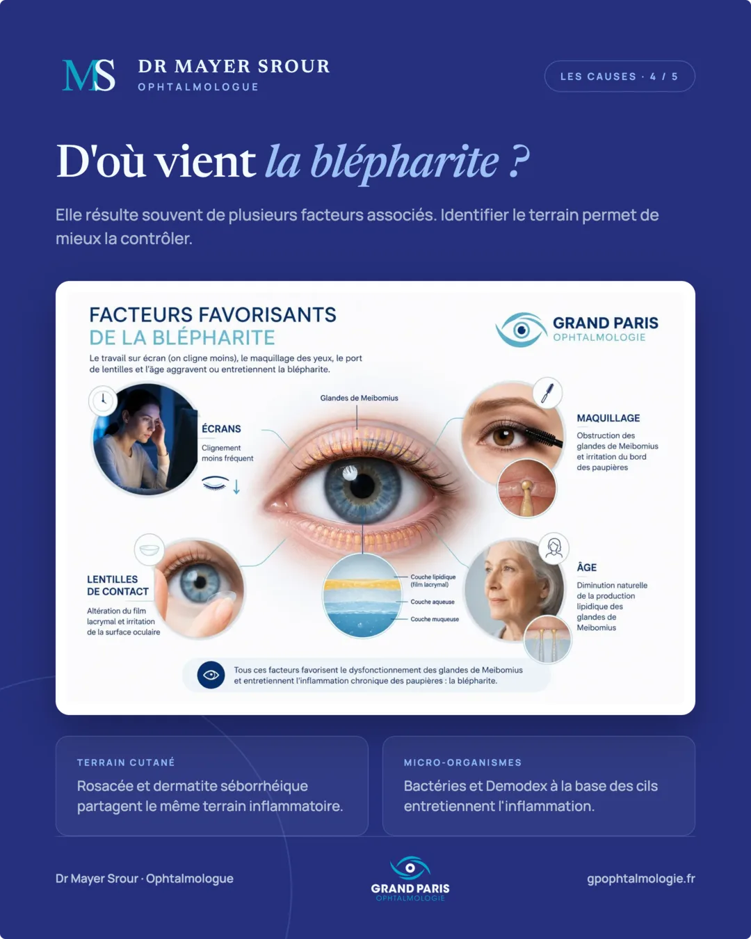 Visuel 4 sur 5 — D'où vient la blépharite ?