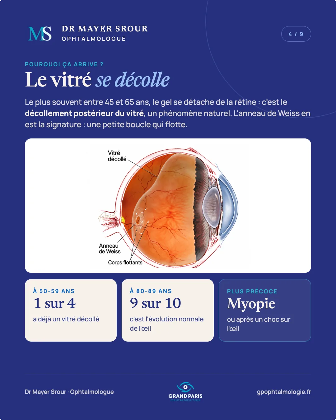 Visuel 4 sur 9 — Le vitré se décolle