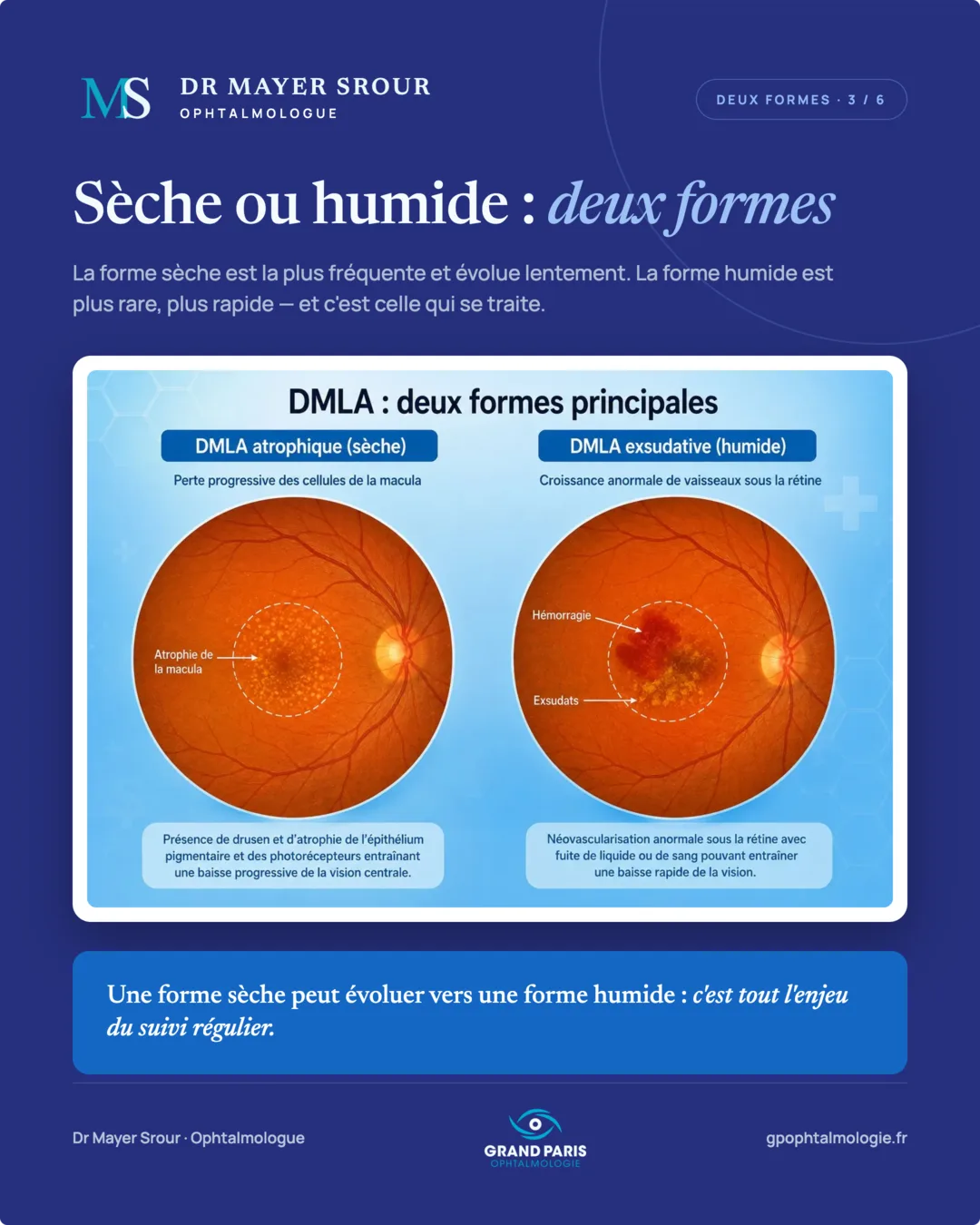Visuel 3 sur 6 — Sèche ou humide : deux formes