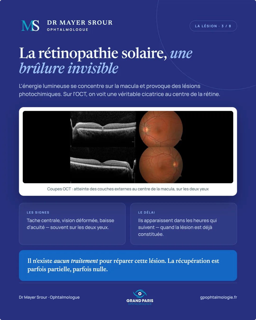 Visuel 3 sur 8 — La rétinopathie solaire, une brûlure invisible