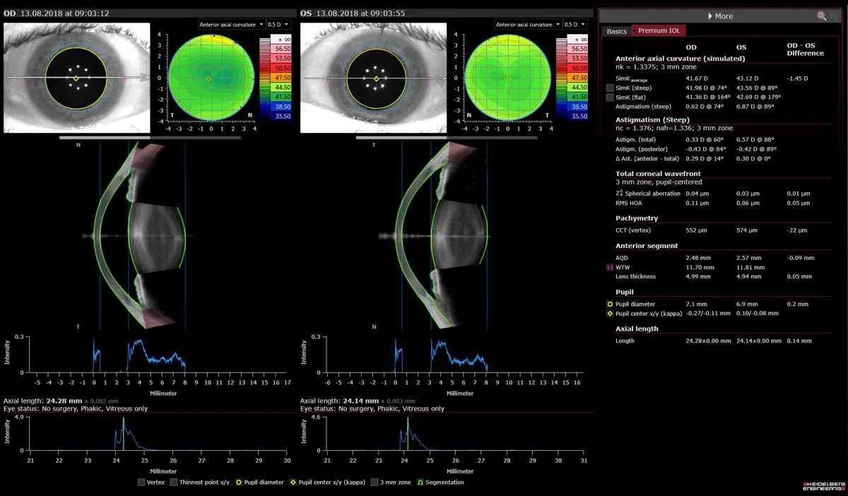 Rapport de biométrie Anterion des deux yeux : topographie de la courbure cornéenne, coupes OCT du segment antérieur, mesures de longueur axiale (24,28 et 24,14 mm), pachymétrie et données pour implant premium
