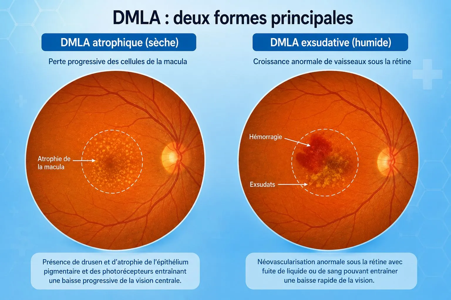 Infographie comparant les deux formes de DMLA au fond d'œil : atrophique (sèche) avec atrophie de la macula et drusen, exsudative (humide) avec hémorragie et exsudats