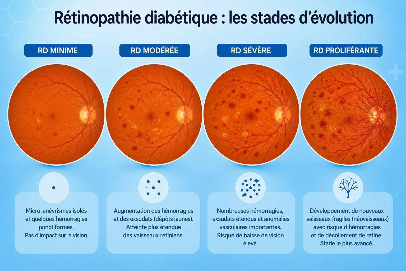 Infographie : les 4 stades d'évolution de la rétinopathie diabétique au fond d'œil — minime, modérée, sévère, proliférante