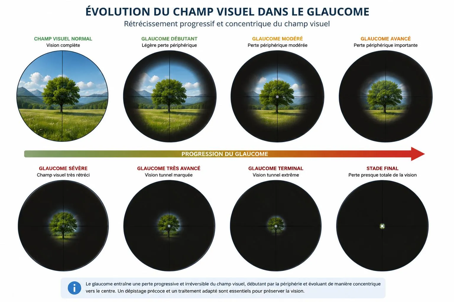 Infographie : évolution du champ visuel dans le glaucome, du champ complet à la vision tunnel — rétrécissement progressif et concentrique