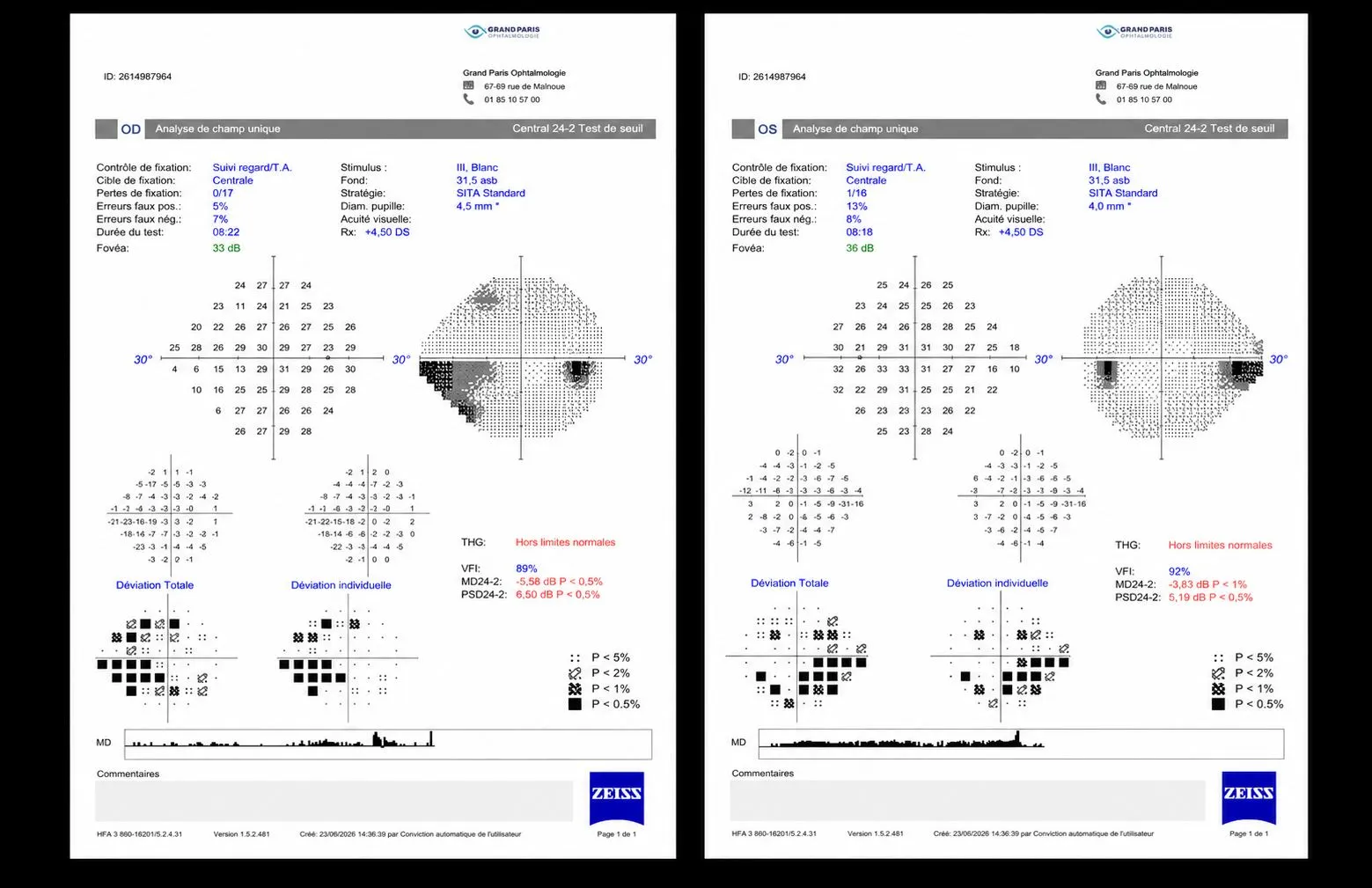 Relevé de champ visuel des deux yeux réalisé au cabinet Grand Paris Ophtalmologie
