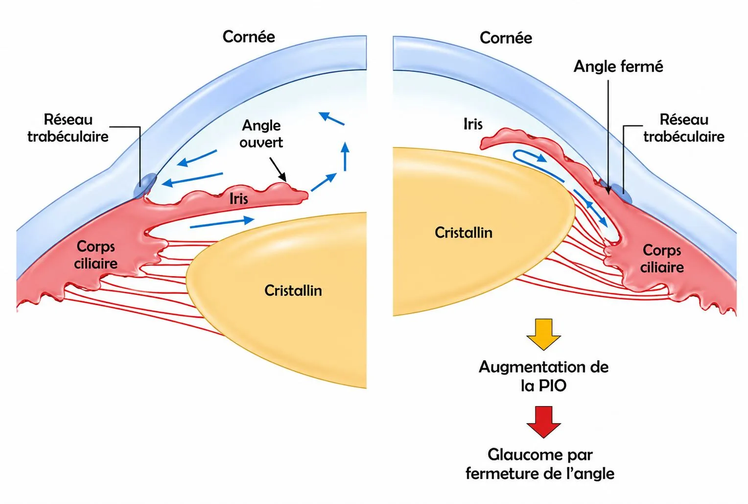 Schéma : angle ouvert avec circulation normale de l'humeur aqueuse vers le réseau trabéculaire, contre angle fermé bloquant l'évacuation — augmentation de la pression intraoculaire et glaucome par fermeture de l'angle