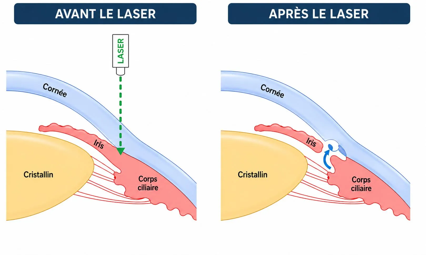 Schéma avant / après l'iridotomie au laser YAG : le laser crée un micro-passage dans l'iris qui rétablit la circulation de l'humeur aqueuse