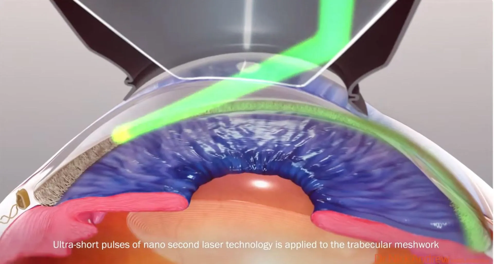 Vue 3D du laser SLT : des impulsions ultra-courtes sont appliquées sur le trabéculum, à travers un verre gonioscopique, pour améliorer l'évacuation de l'humeur aqueuse