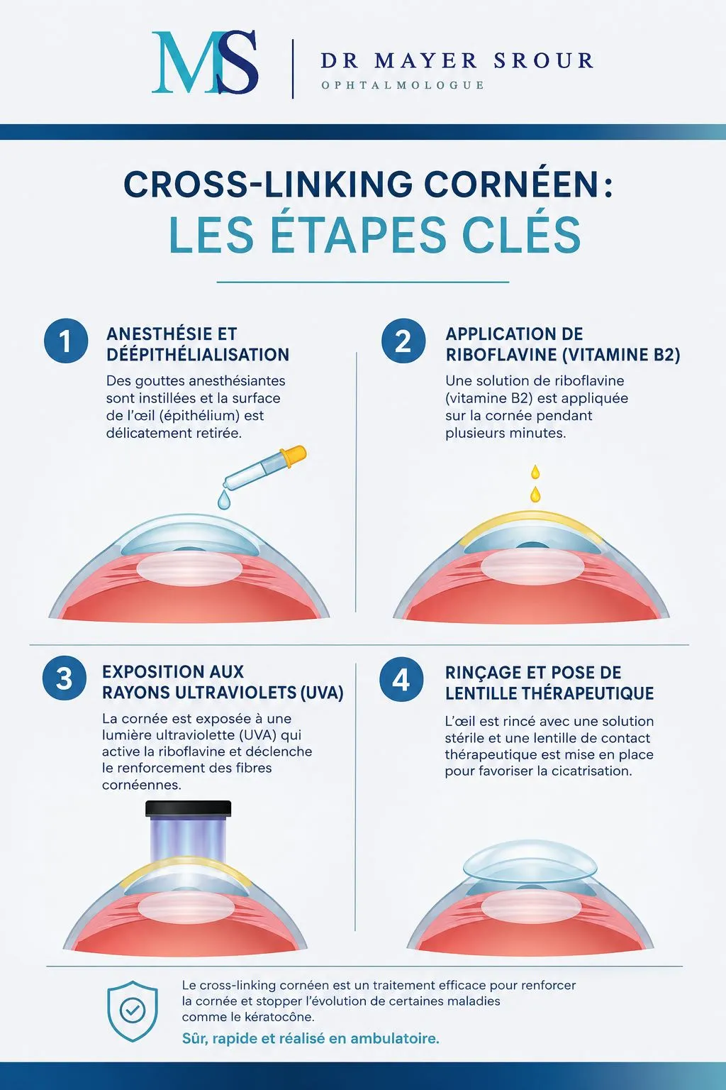 Infographie des étapes du cross-linking cornéen : anesthésie et déépithélialisation, application de riboflavine (vitamine B2), exposition aux UV-A, rinçage et pose d'une lentille thérapeutique
