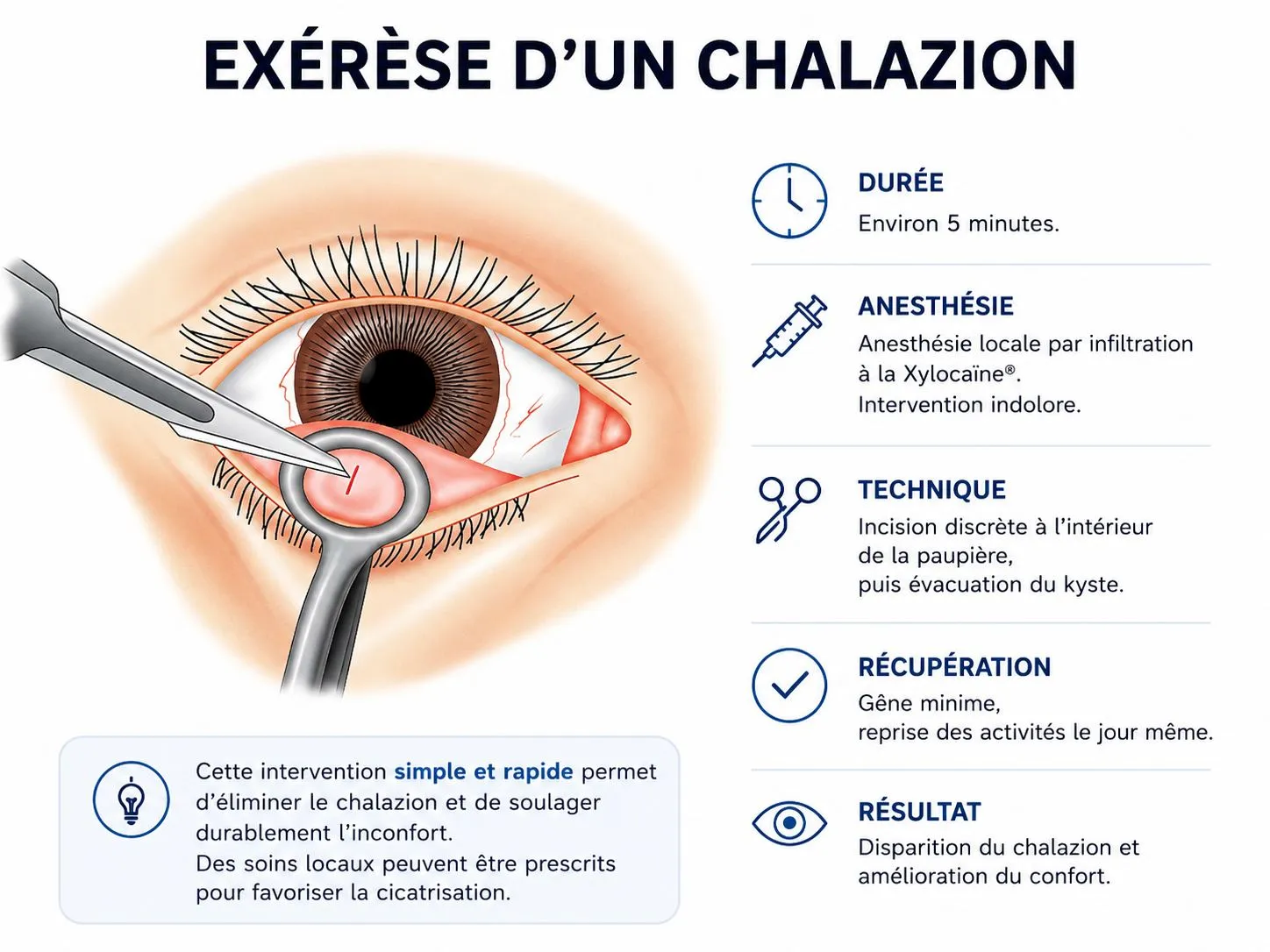 Exérèse d'un chalazion : durée environ 5 minutes, anesthésie locale indolore, incision discrète à l'intérieur de la paupière et évacuation du kyste, récupération le jour même, disparition du chalazion
