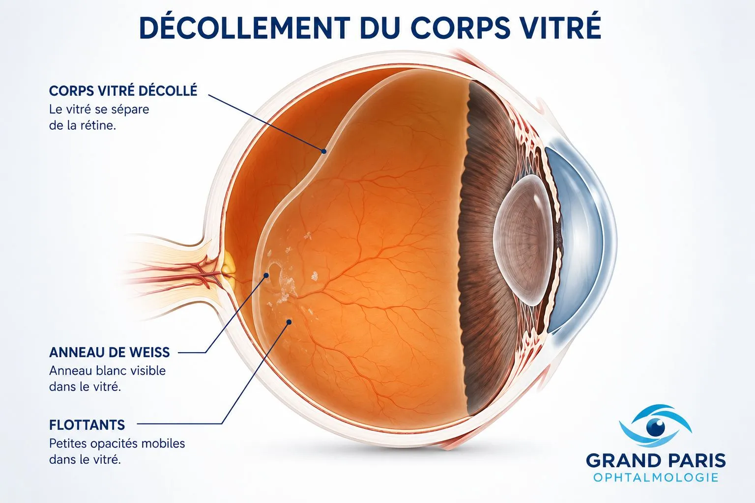 Coupe de l'œil illustrant le décollement du corps vitré : le vitré se sépare de la rétine, avec l'anneau de Weiss et les corps flottants