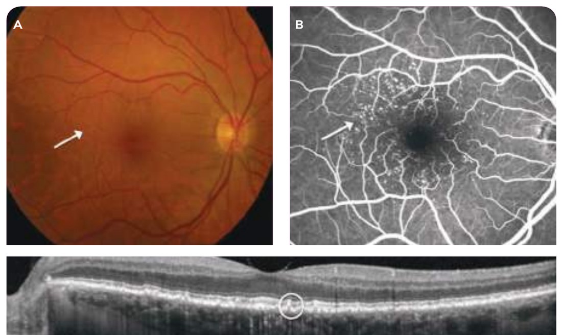 Fig. 2 — Drusen miliaires.