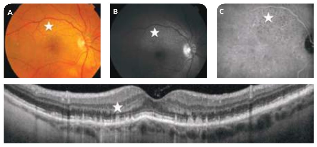 Fig. 5A — Pseudo-drusen réticulés.