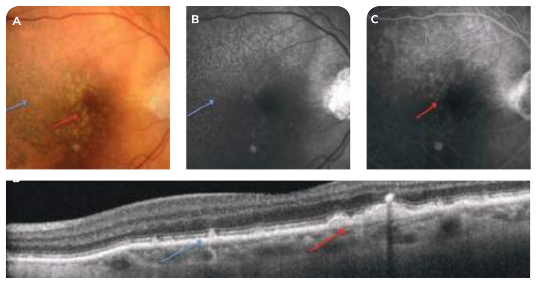 Fig. 5B — Drusen séreux et pseudo-drusen réticulés.