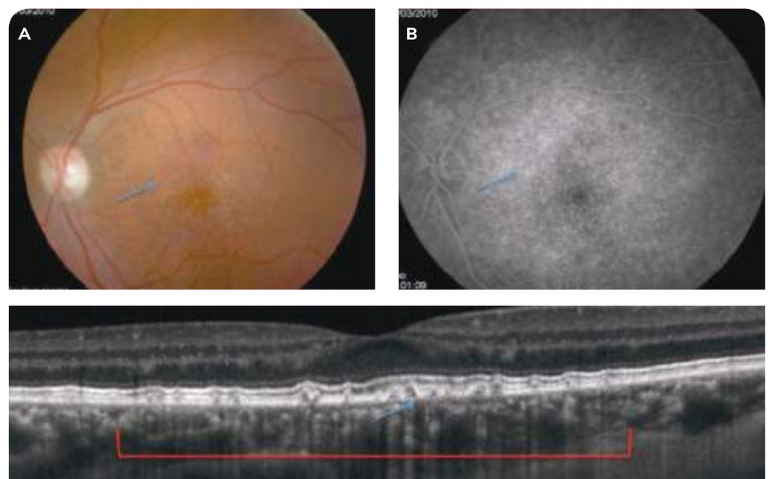 Fig. 6 — Drusen cuticulaires.