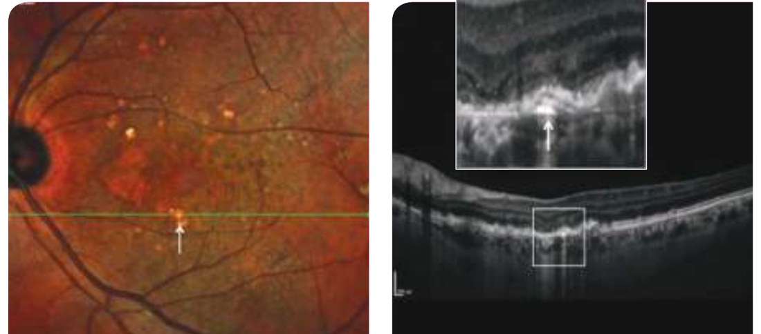 Fig. 7 — Drusen régressif calcifié.