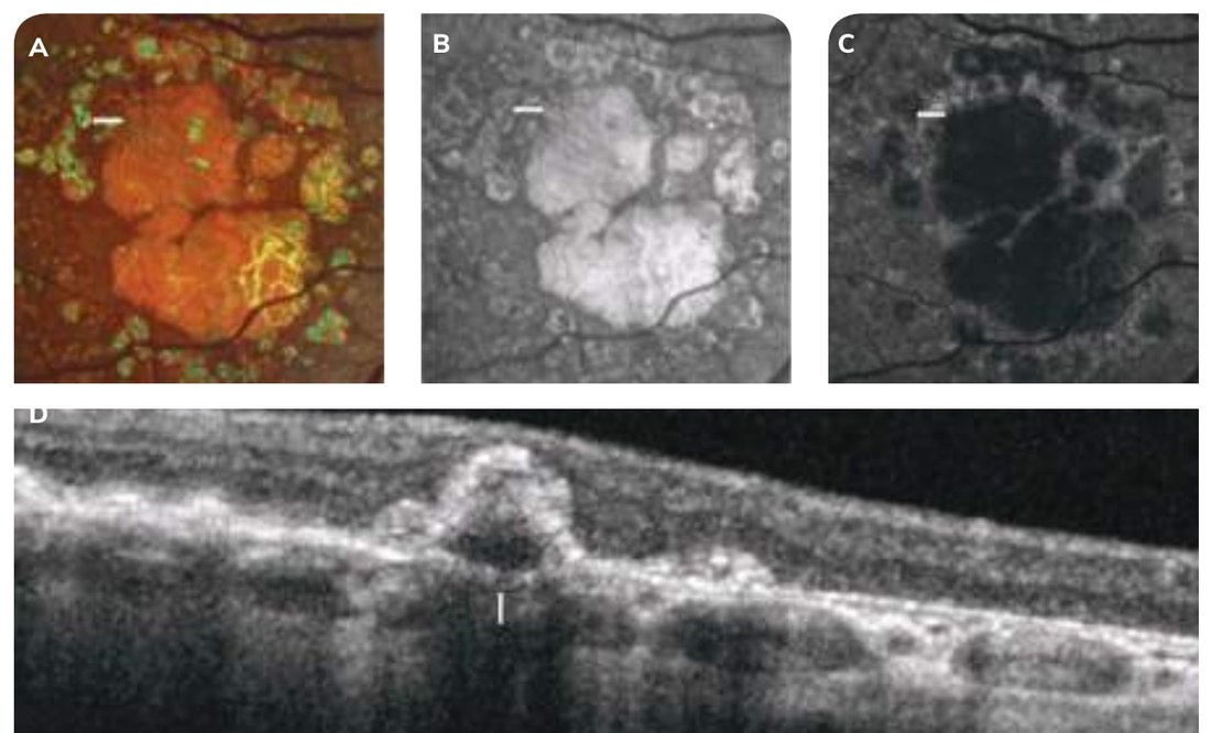 Fig. 8 — Ghost drusen.