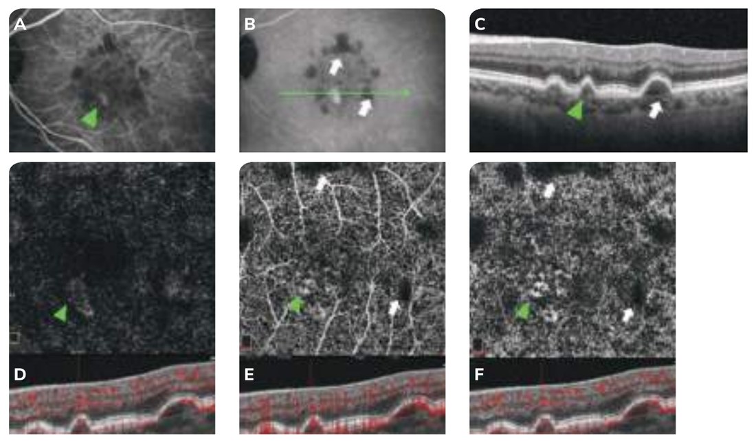 Fig. 9 — Imagerie multimodale d'un patient présentant des drusen séreux et un drusen vascularisé.