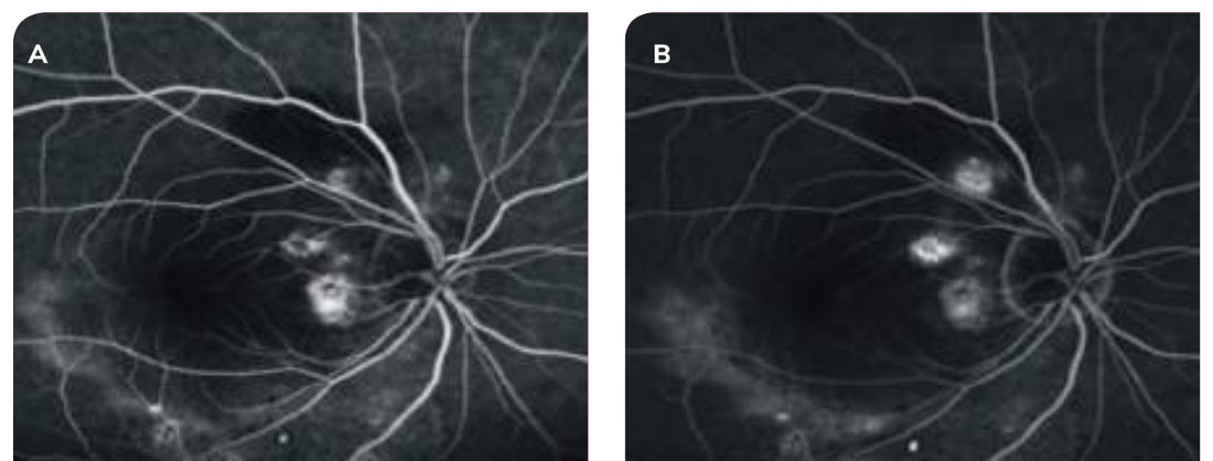Fig. 3 — Angiographie à la fluorescéine temps précoce (A) et temps tardif (B).