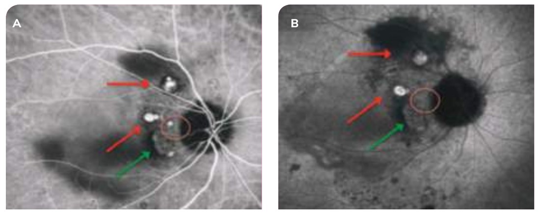 Fig. 4 — Angiographie au vert d'indocyanine temps précoce (A) et temps tardif (B).