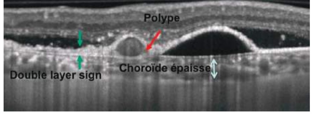 Fig. 5 — Aspect en SD-OCT de la vasculopathie polypoïdale choroïdienne.