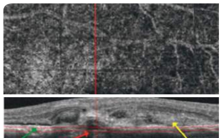 Fig. 6 — VPC associée à des néovaisseaux choroïdiens de Type 2 chez un patient naif de traitement.