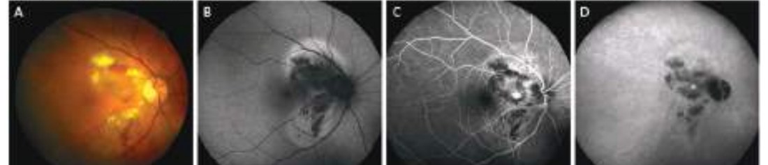 Fig. 8 — Imagerie multimodale d'une vasculopathie polypoïdale hémorragique de Type 2.