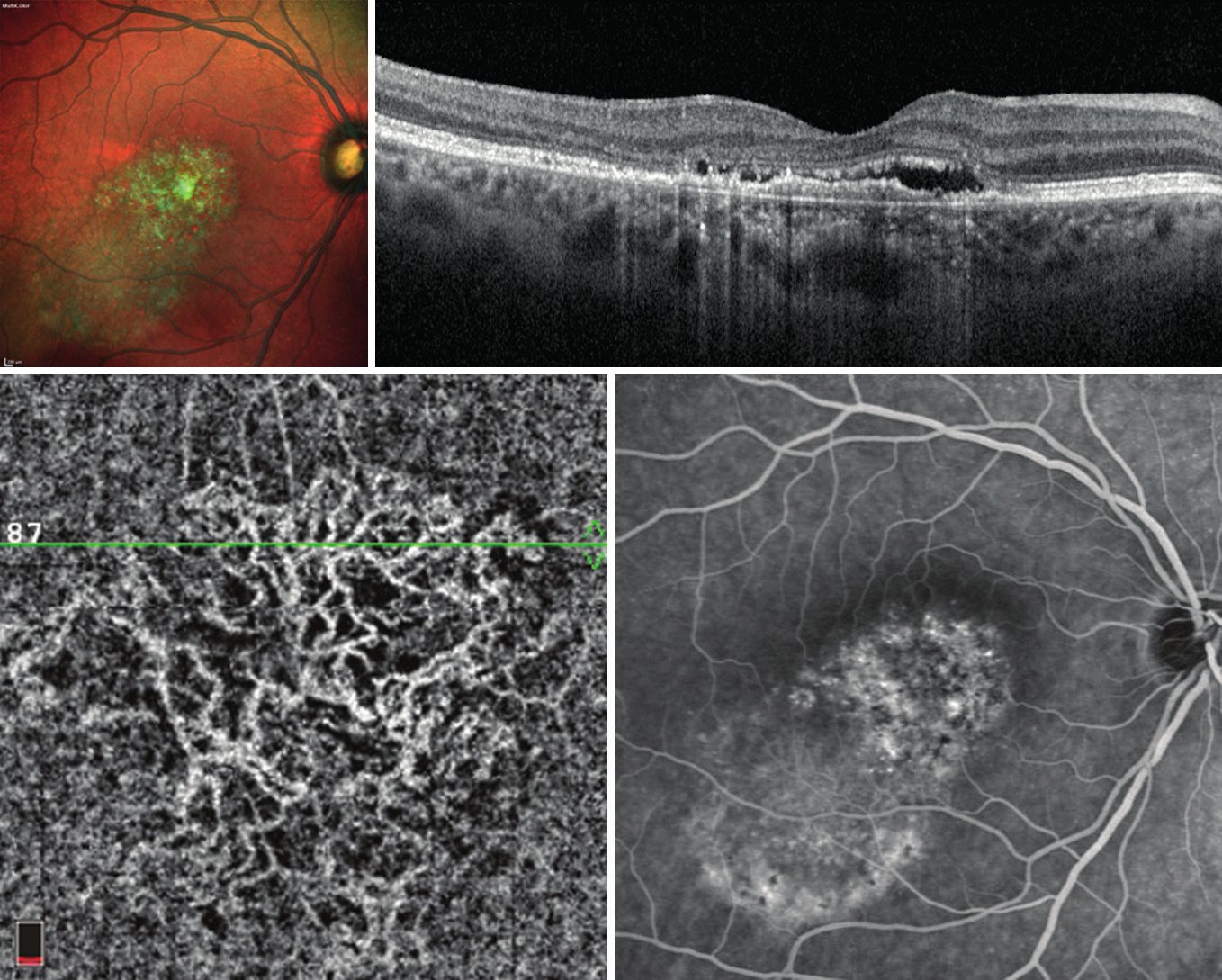 Pachychoroid neovasculopathy：OCT 显示色素上皮平坦型脱离，OCT血管成像显示新生血管