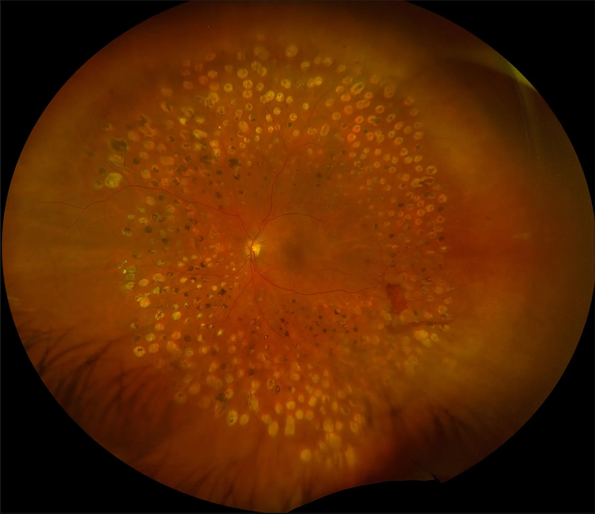 Rétinophotographie ultra grand champ après photocoagulation panrétinienne : les impacts de laser Argon couvrent la périphérie de la rétine, en épargnant le centre (macula) et la papille