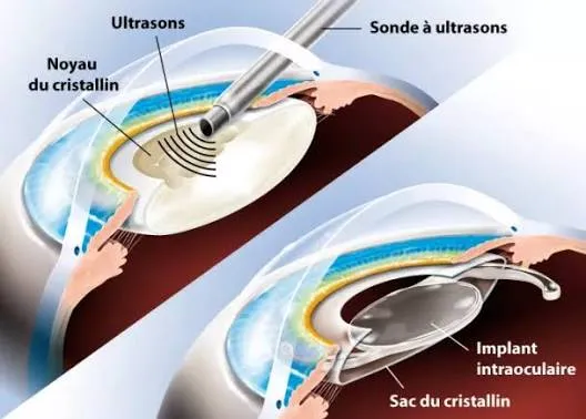 Chirurgie de la cataracte : comment ça se passe