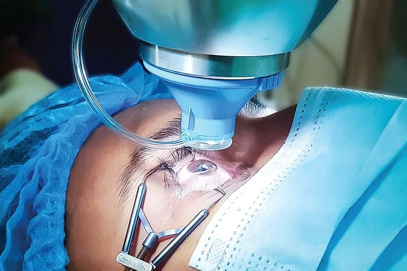 Chirurgie réfractive au laser : patient sous le laser, œil maintenu par un blépharostat