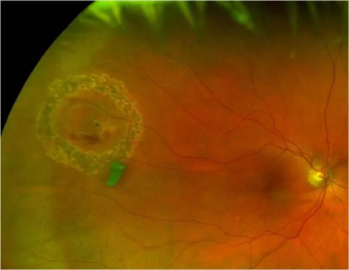 Rétinophotographie : déchirure rétinienne entourée d'un barrage de photocoagulation au laser Argon — les impacts pigmentés forment un anneau cicatriciel qui verrouille la lésion