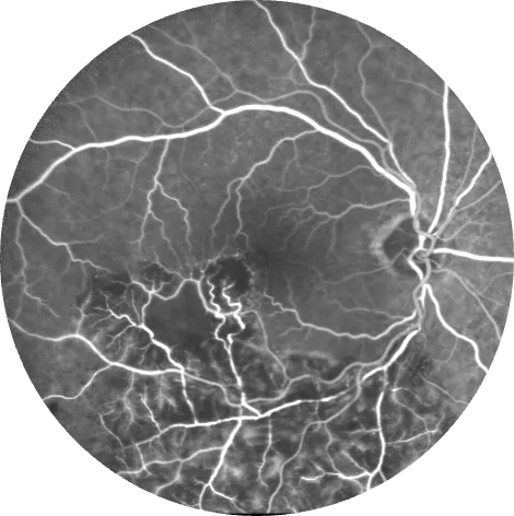 Cliché d'angiographie à la fluorescéine : occlusion de branche veineuse temporale inférieure, avec fuites et zones de mauvaise perfusion dans le territoire atteint