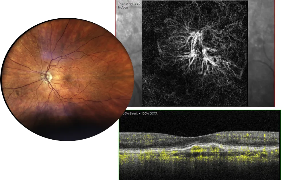 OCT-Angiographie : cartographie des vaisseaux rétiniens sans colorant