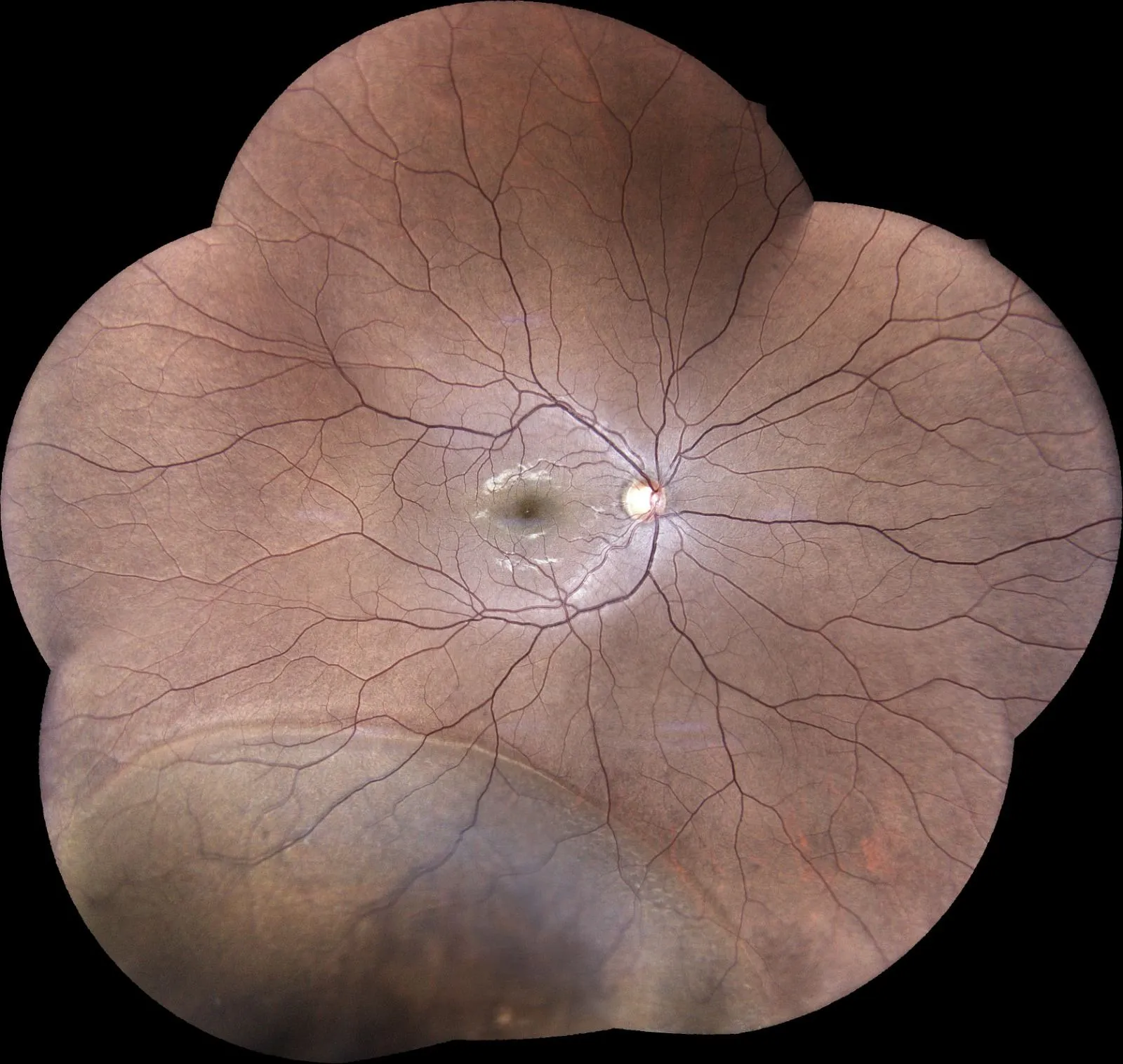 Rétinophotographie ultra grand champ réelle : vue panoramique du fond d'œil montrant la macula, le nerf optique et le réseau vasculaire jusqu'à la périphérie de la rétine