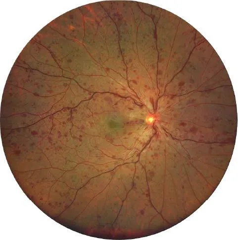 Fond d'œil d'une occlusion de la veine centrale : hémorragies dans les quatre quadrants, veines dilatées et tortueuses