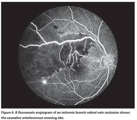 Angiographie à la fluorescéine d'une occlusion de branche ischémique : territoire rétinien non perfusé au niveau d'un croisement artério-veineux