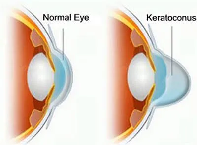 Comparaison d'un œil normal et d'un œil atteint de kératocône : dans le kératocône, la cornée s'amincit et se bombe en forme de cône