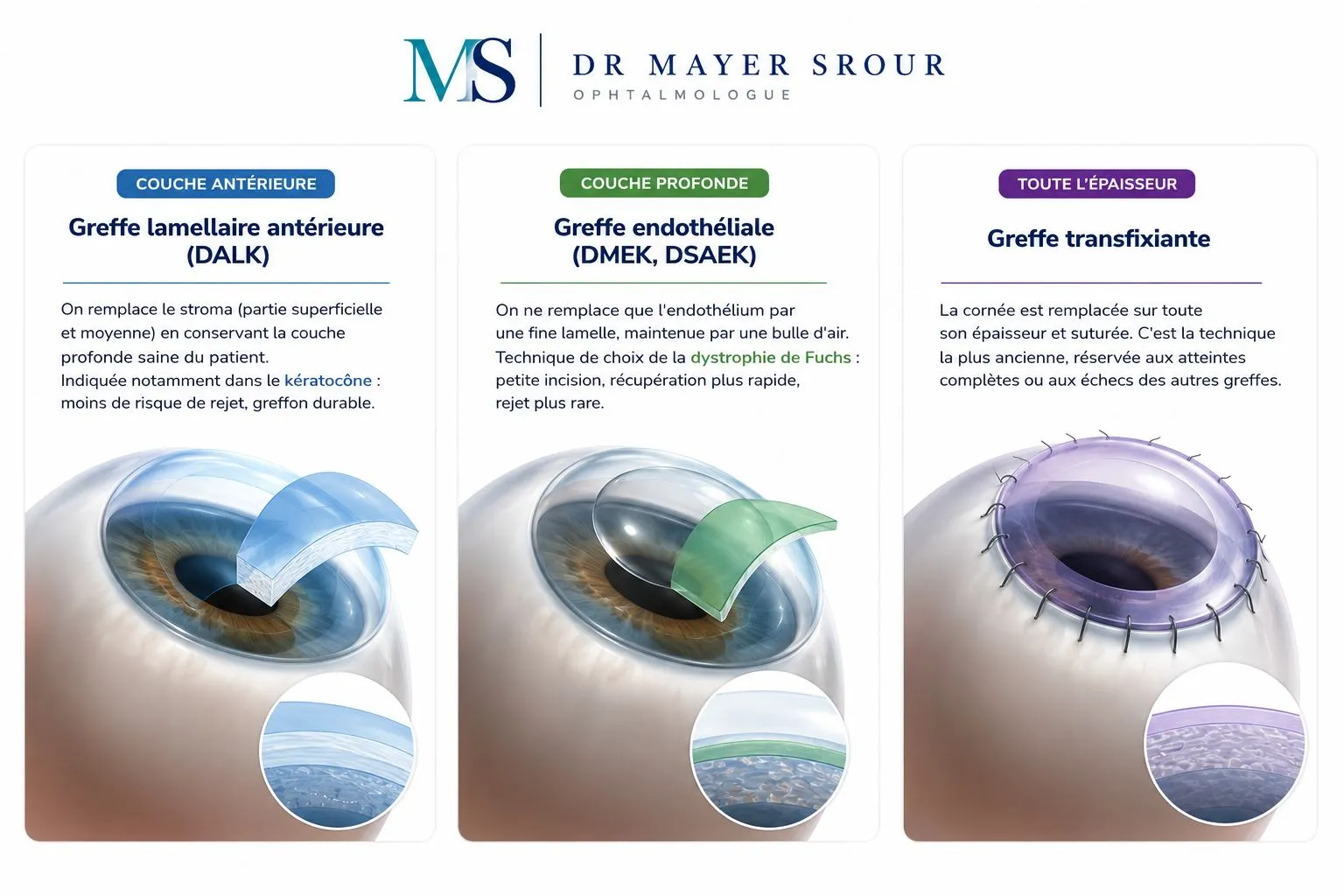 Infographie des trois techniques de greffe de cornée : greffe lamellaire antérieure (DALK), greffe endothéliale (DMEK, DSAEK) et greffe transfixiante