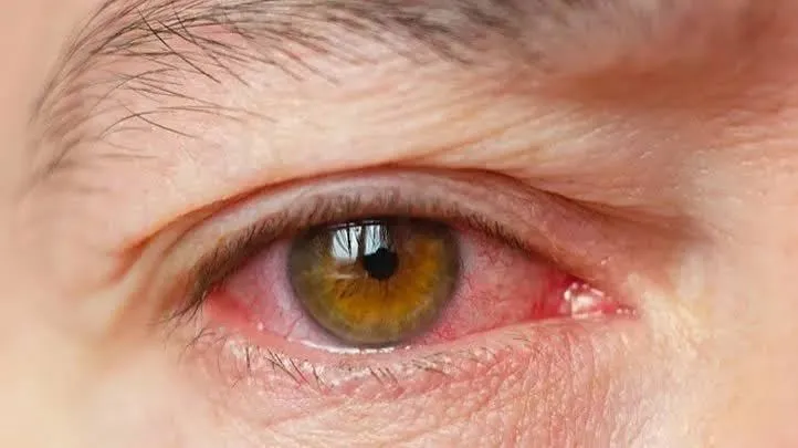 Paupière rouge et irritée par une blépharite : bord de la paupière enflammé à la base des cils