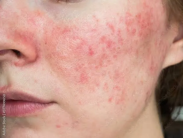 Rosée cutanée du visage : rougeurs diffuses des joues, souvent associées à une blépharite