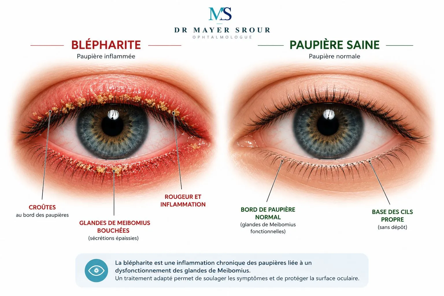 Comparaison d'une paupière atteinte de blépharite (rouge, enflammée, croûtes, glandes de Meibomius bouchées) et d'une paupière saine (bord normal, base des cils propre)