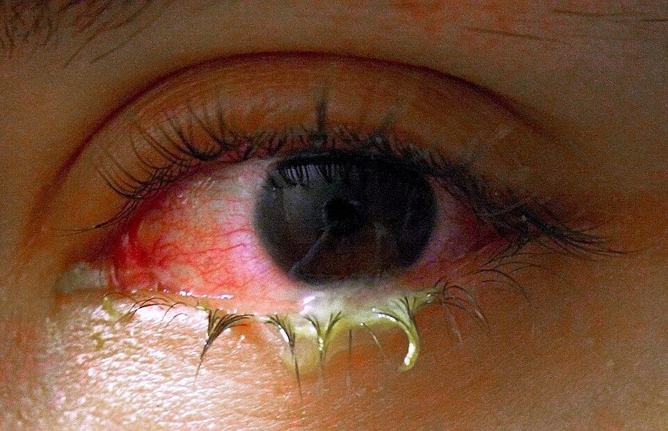 Œil atteint de conjonctivite : blanc de l'œil très rouge et sécrétions jaunes le long des cils, typiques d'une conjonctivite bactérienne