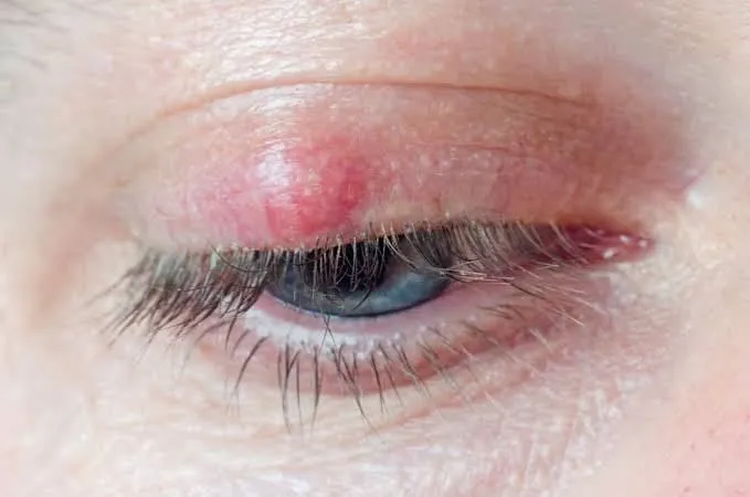 Chalazion de la paupière supérieure : boule rouge et ferme dans l'épaisseur de la paupière