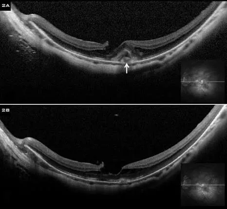 OCT maculaire d'une myopie forte : maculopathie myopique avec staphylome et anomalies de l'interface vitréo-maculaire