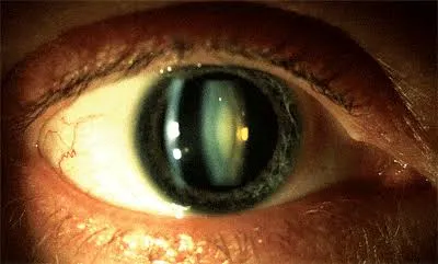 Œil atteint de cataracte : cristallin devenu opaque, plus fréquent et plus précoce chez le myope fort