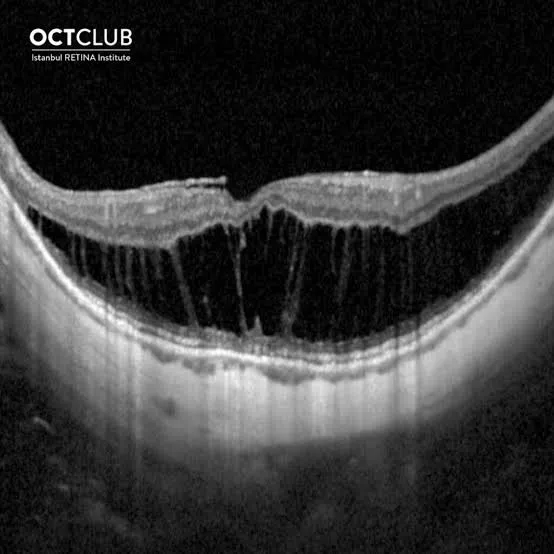 OCT maculaire : fovéoschisis myopique