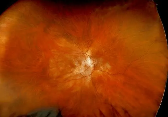 Rétinophotographie grand champ d'un myope fort